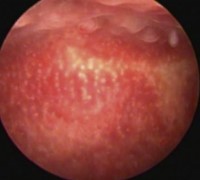 Οξεία ενδομητρίτιδα