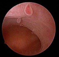 Μικροκυστικοί πολύποδες