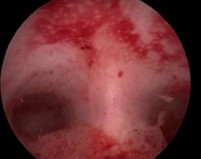 Ενδομητρικό διάφραγμα