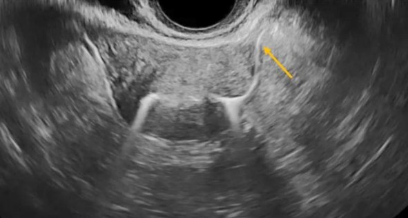 Υπερηχογραφική Σαλπιγγογραφία