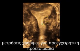 Τρισδιάστατος Υπέρηχος