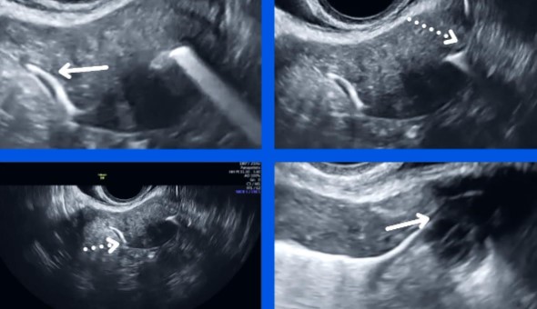 Υπερηχογραφική Σαλπιγγογραφία