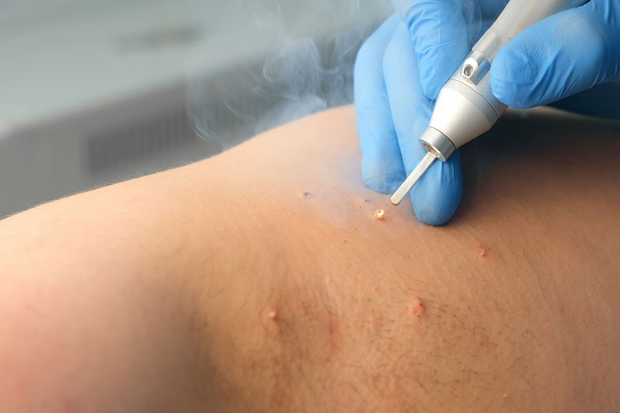 Καυτηριασμός κονδυλωμάτων HPV